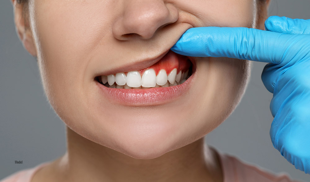 close-up of woman's teeth as someone with blue gloves lifts her lip to show healthy gums.